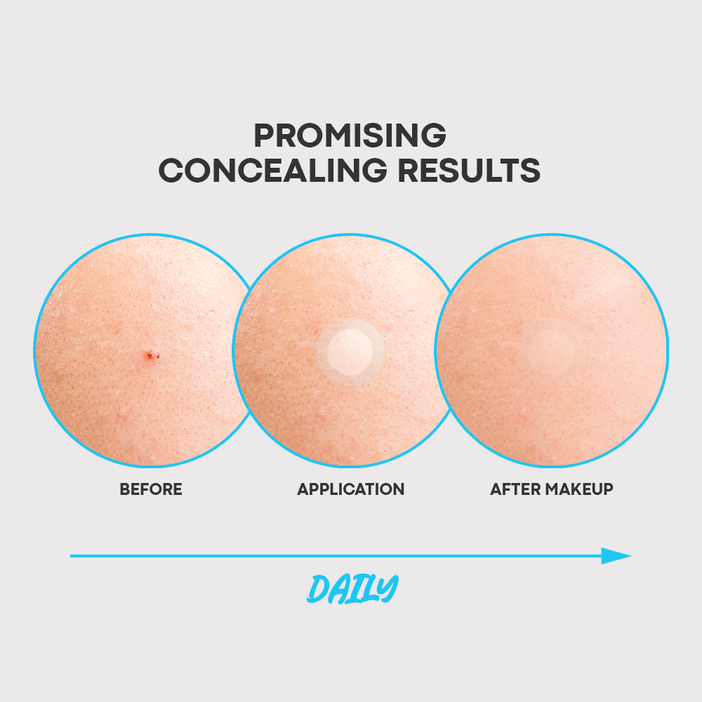 No More Breakouts Set